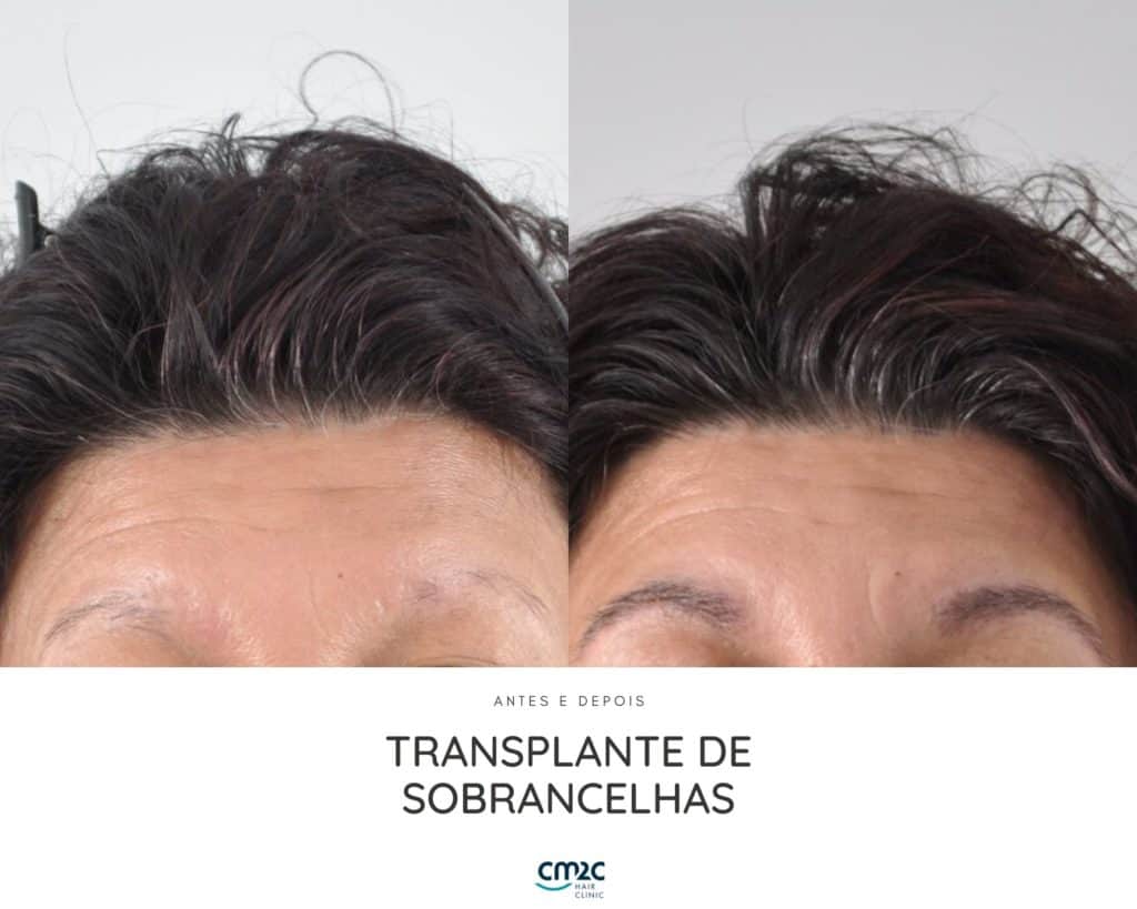 CM2C - Transplante de Sobrancelhas Antes e Depois