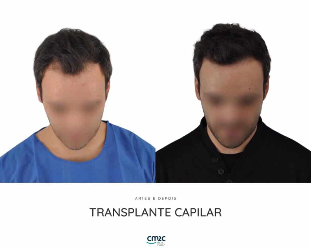 CM2C - Transplante Capilar Antes e Depois
