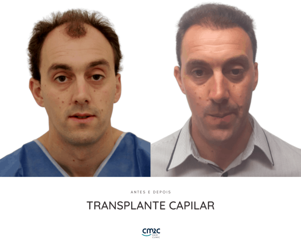 CM2C - Transplante Capilar Antes e Depois